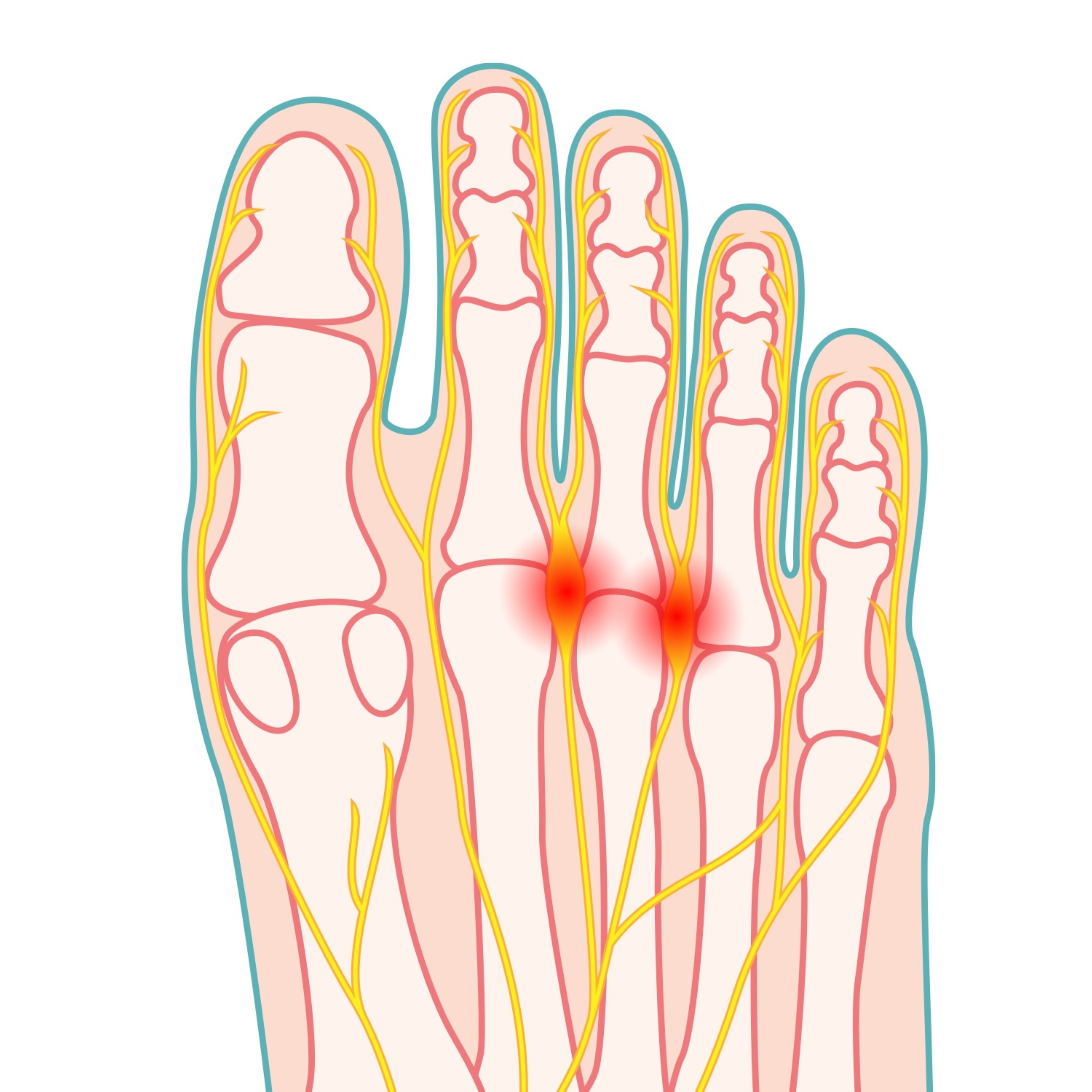 Immagine della patologia Neuroma di Morton