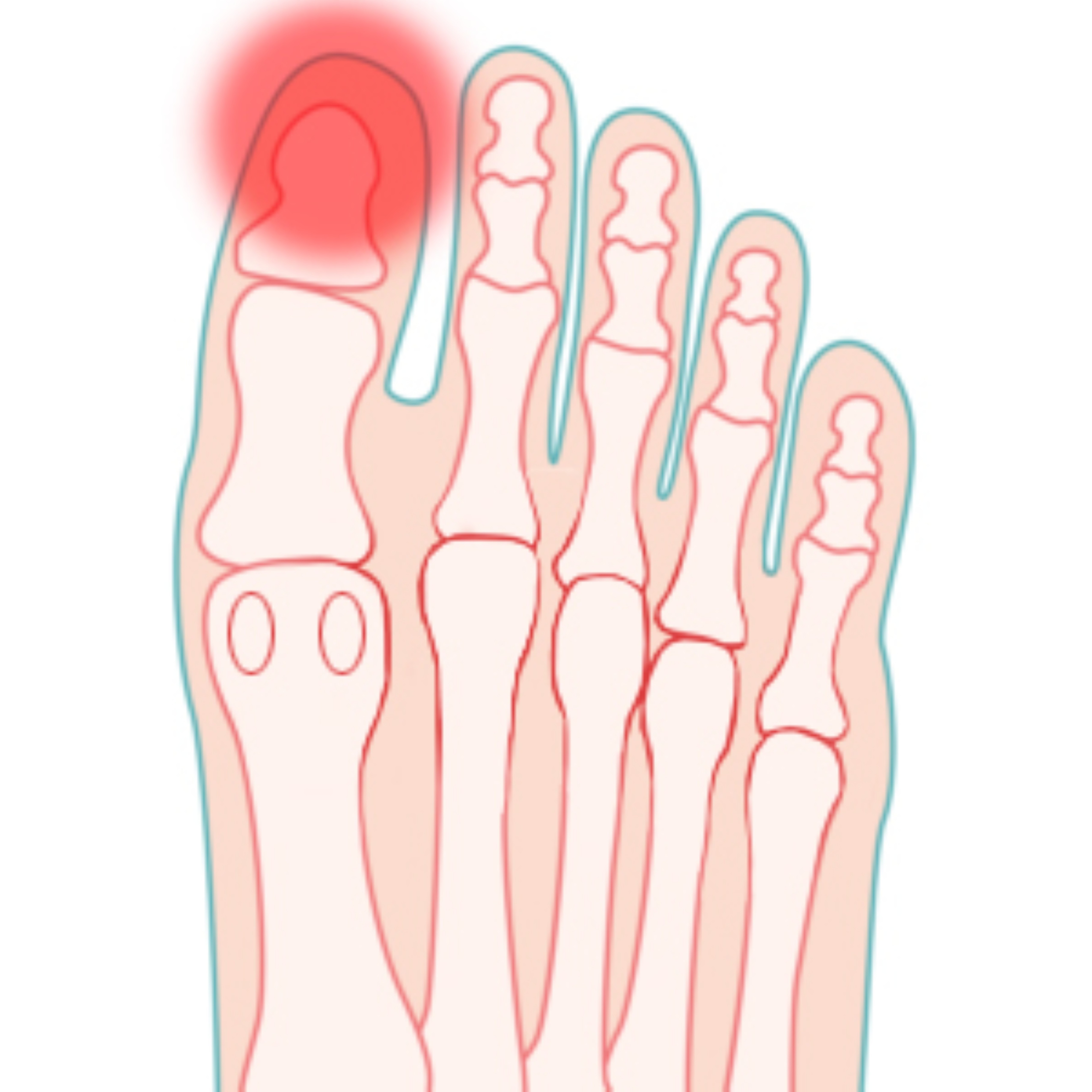 Immagine della patologia Onicocriptosi